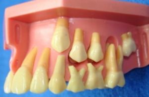 recambio-dentario
